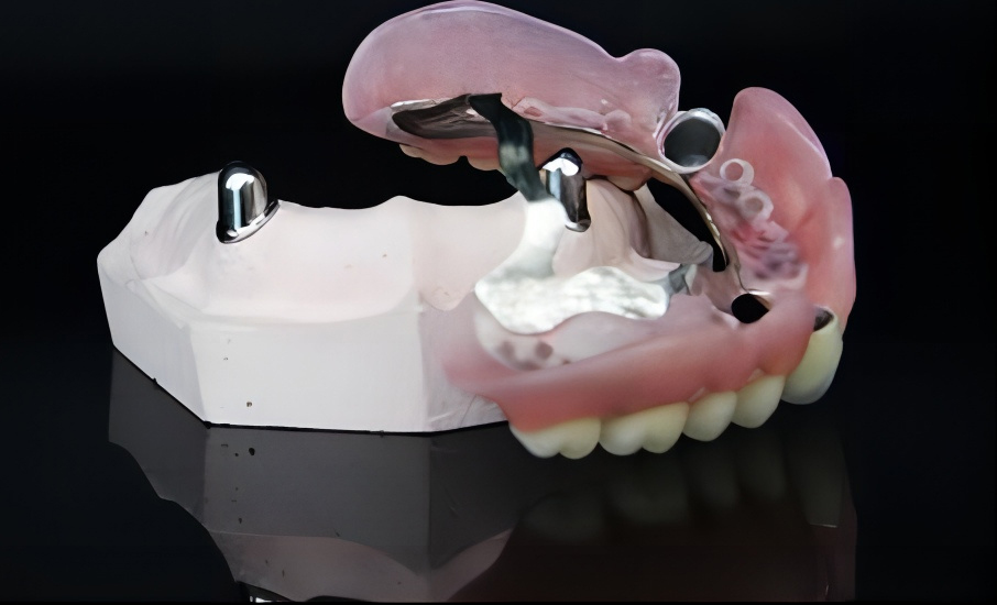 Telescope crowns combo with framework
