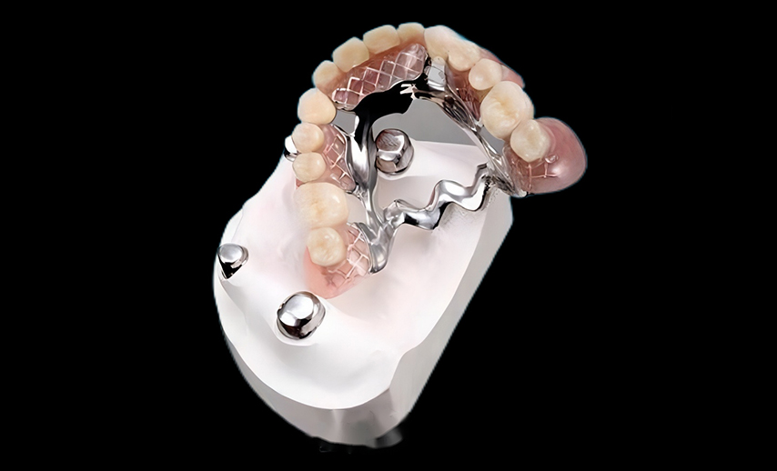 Telescope crowns combo with framework