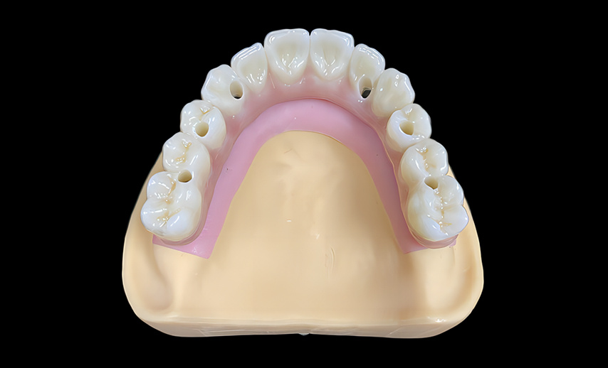 Implant bar with bridge in one piece