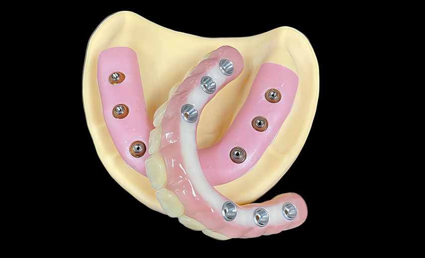 Zirconia bridge over implant abutment