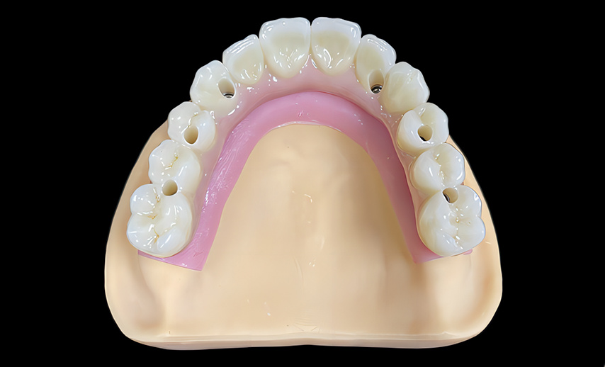 Zirconia bridge over implant abutment