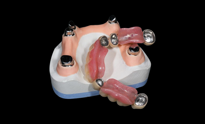 Telescope crowns combo with framework
