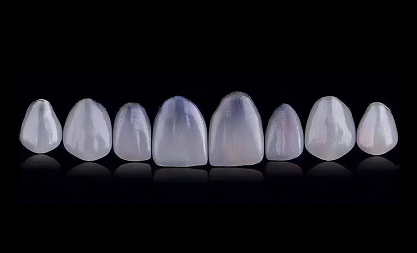 All-ceramic veneer