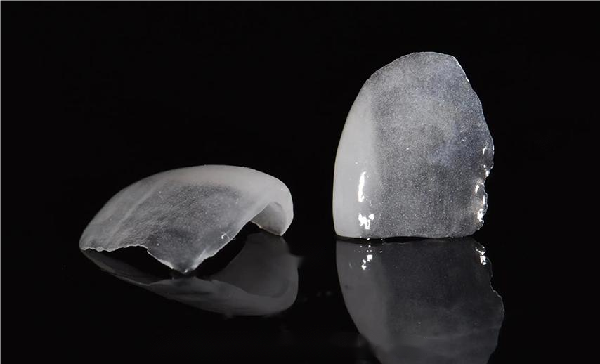 All-ceramic veneer