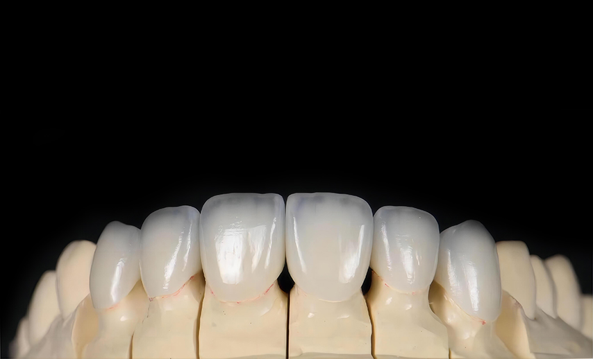 All-ceramic veneer