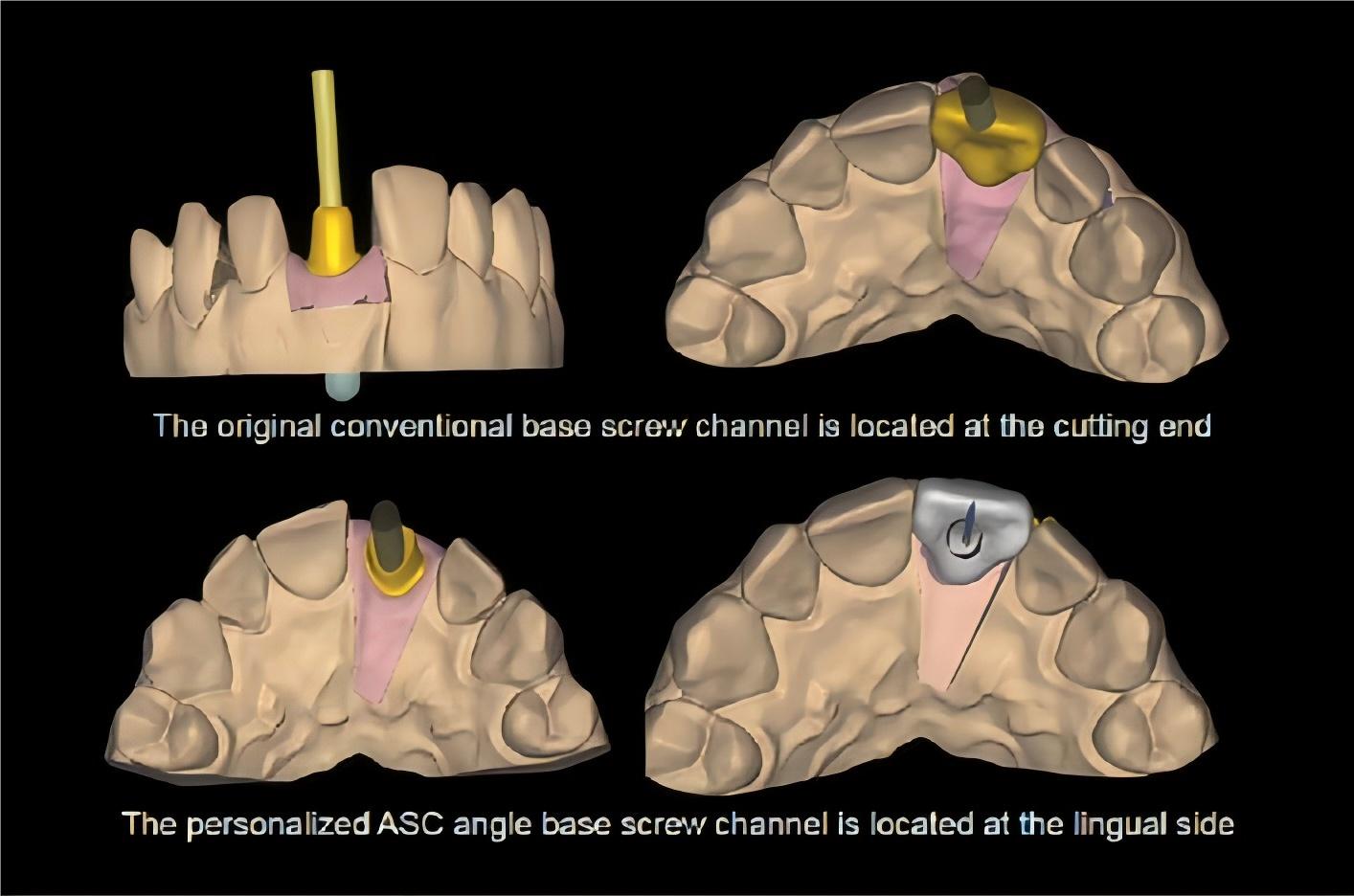 ASC abutment