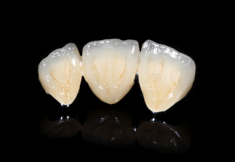 Porcelain Fused  to Metal Crown