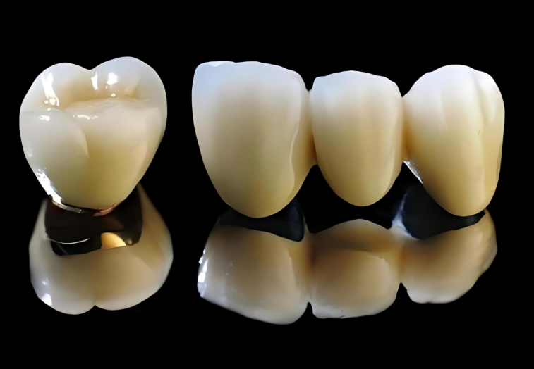 Porcelain Fused  to Metal Crown