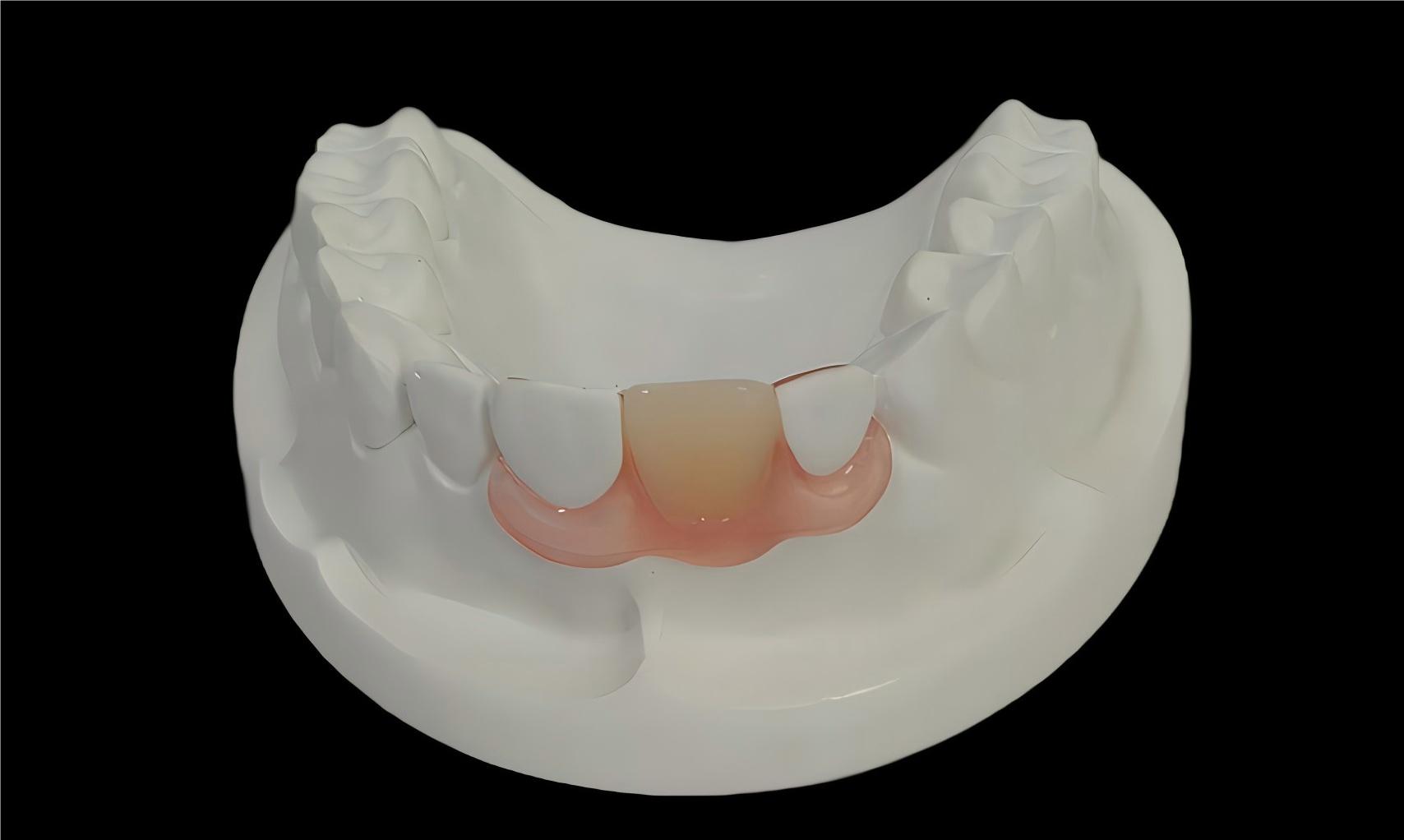 Valplast/Flexible  partial  denture