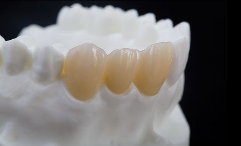 Full zirconia