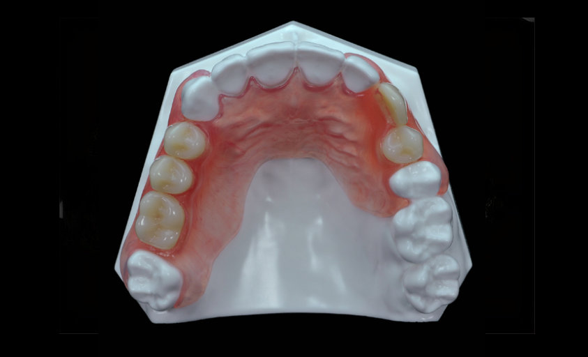 Valplast/Flexible  partial  denture