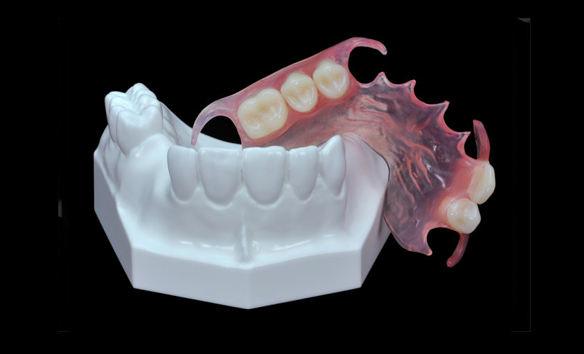 Valplast/Flexible  partial  denture