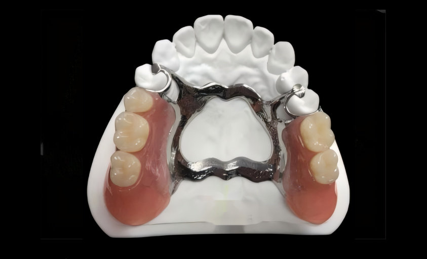 Cast  framework  with  teeth