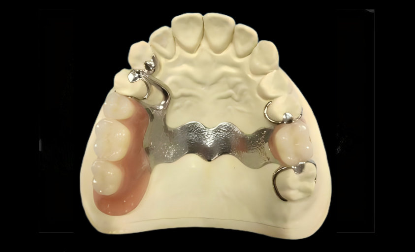 Cast  framework  with  teeth
