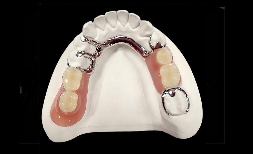 Cast  framework  with  teeth