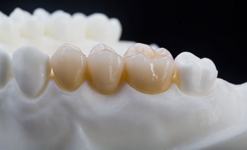 Full zirconia
