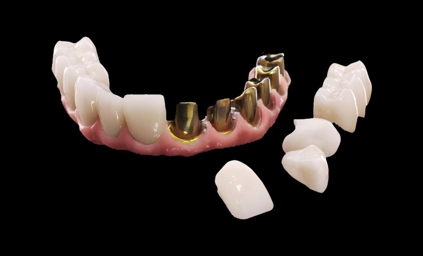Hybrid bridge single units restoration