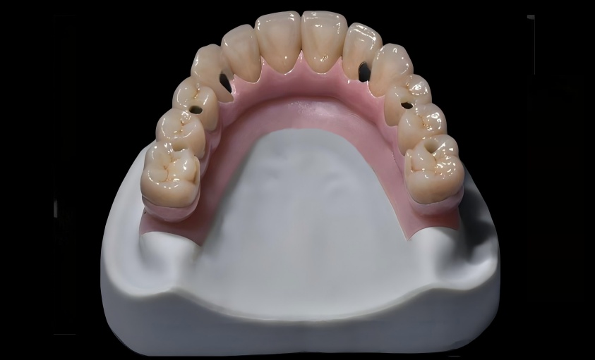 Hybrid bridge single units restoration
