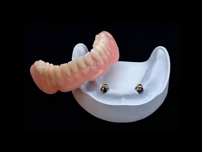 Implants