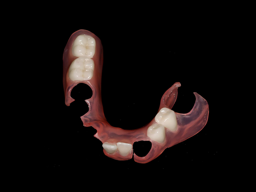 Removable Restorations