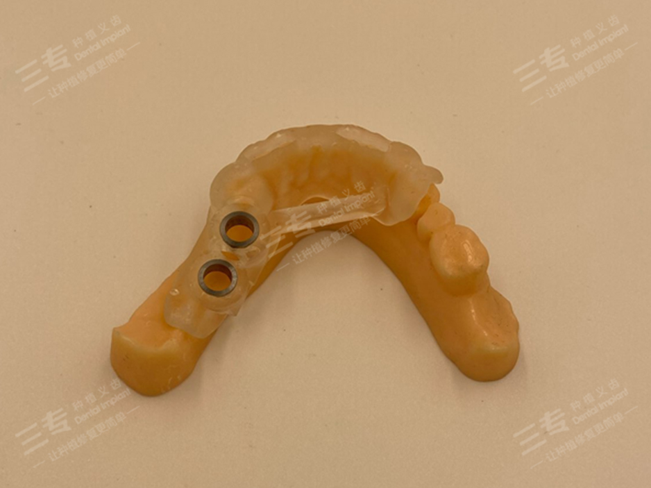 Implant Surgical Guide