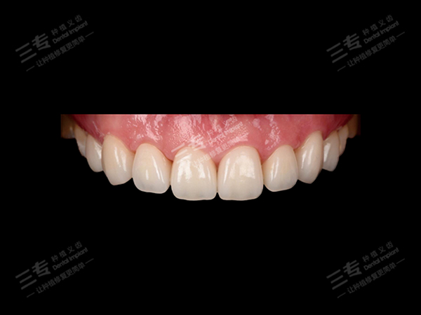Veneer