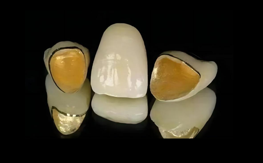 PFM Nobel Crowns