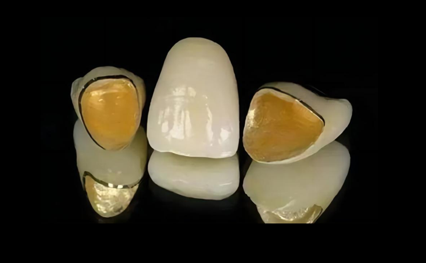 Nobel PFM teeth