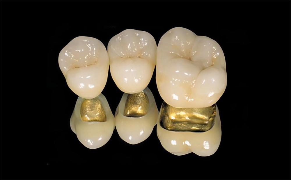 PFM Nobel Crowns