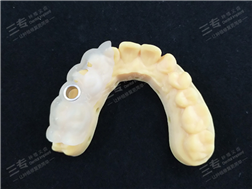 Implant Surgical Guide