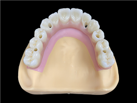 Implant bar with bridge in one piece