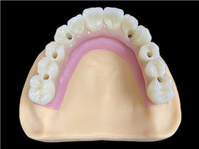 Zirconia bridge over implant abutment