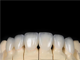 All-ceramic veneer
