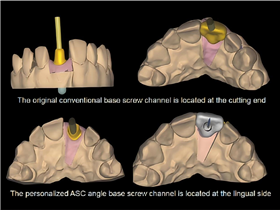 ASC abutment