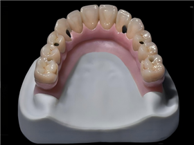Hybrid bridge single units restoration