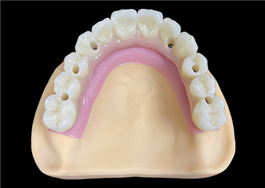 Zirconia bridge over implant abutment
