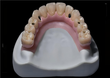 Hybrid bridge single units restoration